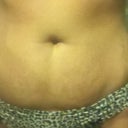 Before tummy tuck...extra skin and stretch marks