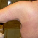 Left Arm - contracure along with "Dog Ears" under arm and side from how I was sutured