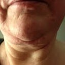 This is my divided, lopsided double chin - after THREE procedures
