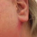 Raised, red, painful scar under left ear lobe