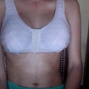 With my 'special' bra on. You can already see improvement in the symmetry