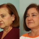 Hair Transplantation