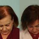 Hair Transplantation