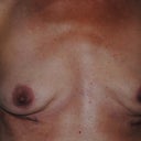 9 days post op