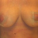 right breast had full lift, with no verticle inciscion scar, incision goes off the lower side off breast instead... I love it!!