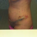 mild bruising, but . swollen. if you  can enlarge this, you can see the direction of the lift incision, hidden by tape now..