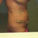 more swelling and slight bruising