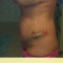 skin irritataion just past my TT incision... the garment stuck to my skin and left a mark!!! ouch