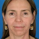 Female Patient Who Wanted Nonsurgical Rejuvenation.
