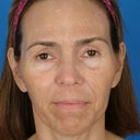 Female Patient Who Wanted Nonsurgical Rejuvenation.