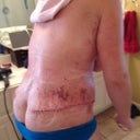 Post Op Day 3 Back II