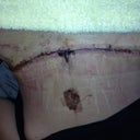 5 days post op laying down