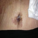 Belly button area 5 days post op