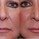 before and after..lips and lines at corners of the mouth treated with Silikon 1000