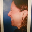 this is a before picture from the Dr's office!!! OMG you  can really see inside my nose