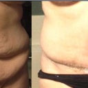 belly pic before and 4 weeks PO
