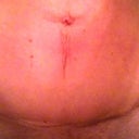 4 weeks post op