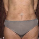 Day 14, most of the bruising gone. Just a very pale green hue left and light bruising on my thighs.