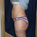 Side view pre surgery