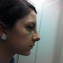 profile after cast came off, tip seems a little high to me but I think everything will settle in. Definitely have swelling everywhere, including between the eyes. It also swelled up more the day after the cast was removed.