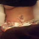 laying down 3 days post op