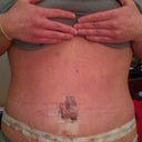 day 4 post op.. or michelin man you decide:) standing up none the less!