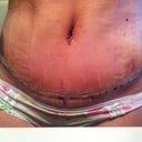Pod 4 close up of incision