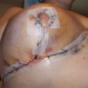 Post op day 3--righty