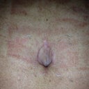 Belly Button at 4 weeks.  My PS has me packing my bb with gauze for 6 weeks.  This is to avoid it losing its round shape.