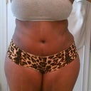 3wks 3 days postop