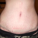 3 weeks post op