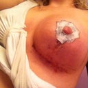My good side. My other side is spitting stiches and a little yucky !