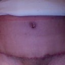 Week 8 and scar healing okay.  Still very red but not so sore to the touch.