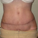 6 weeks after Full TT