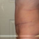 6 weeks after Full TT