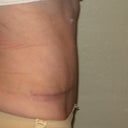 6 weeks after Full TT