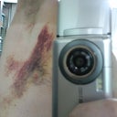 10-day mark... swelling and pain is almost non-existent on the left side, although the internal bleeding from anesthesia injections looks bad still.