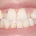 after 7 trays.