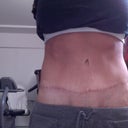 5 months post op