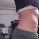 5 months post op
I can't wait to be flat!!!