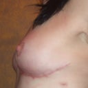 side shot one month post
