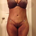 10days post op