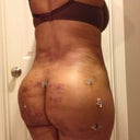 10days post op