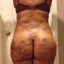 10 days post op