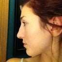 15 days post op...still have the bump.