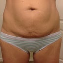 Pre-surgery