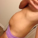 Pre-surgery side view