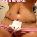 Post -Op Day 2, check out the waistline.