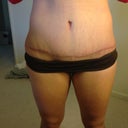 Scar 6 weeks post op