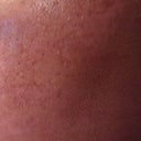 70 hour post-treatment (see the brown flakes?)